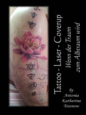 cover image of Tattoo--Laser--Cover Up